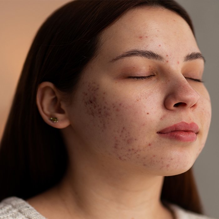 Acne-Scar–Removal